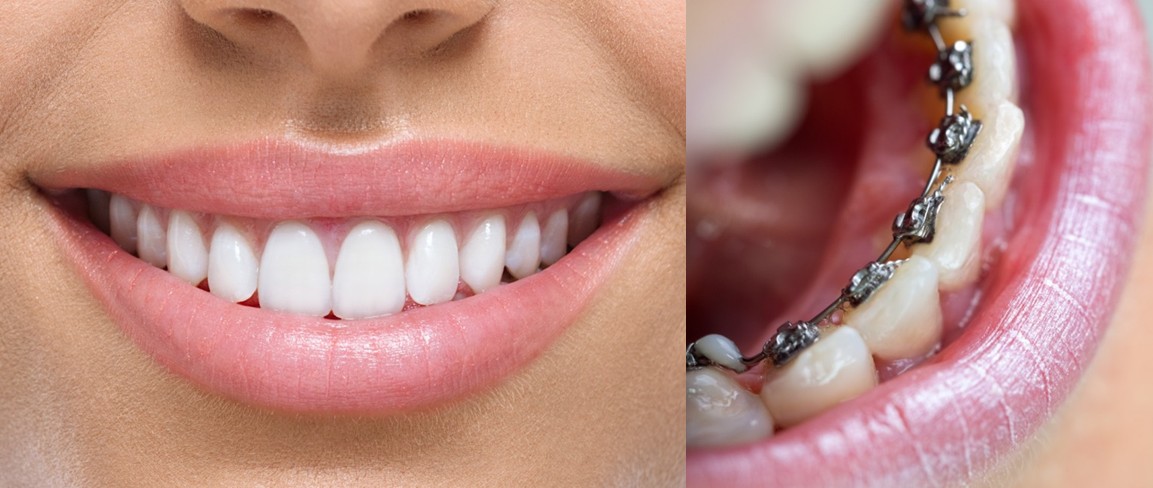 Apparecchi ortodontici - Panoramica dei diversi tipi